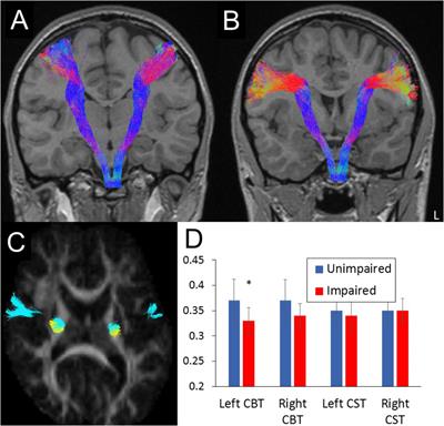 Corticobulbar Tract Injury, Oromotor Impairment and Language Plasticity in Adolescents Born Preterm
